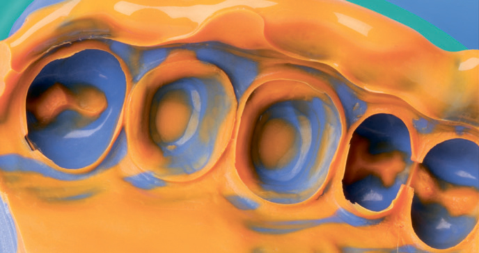 Силагум Лайт - корригиющий силикон